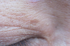 色素沈着(茶色)