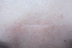 水疱瘡痕(みずぼうそうあと)