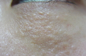 汗管腫(かんかんしゅ)