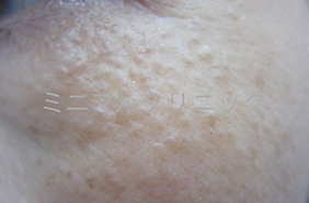 エクリン汗嚢腫(かんのうしゅ)