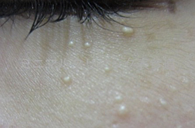 稗粒腫(はいりゅうしゅ、ひりゅうしゅ)