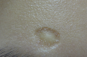 水疱瘡痕(みずぼうそうあと)
