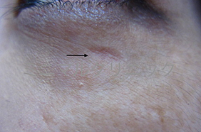 傷痕(きずあと)