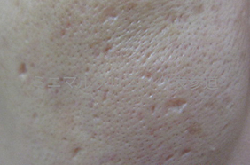 ニキビ痕(にきびあと)